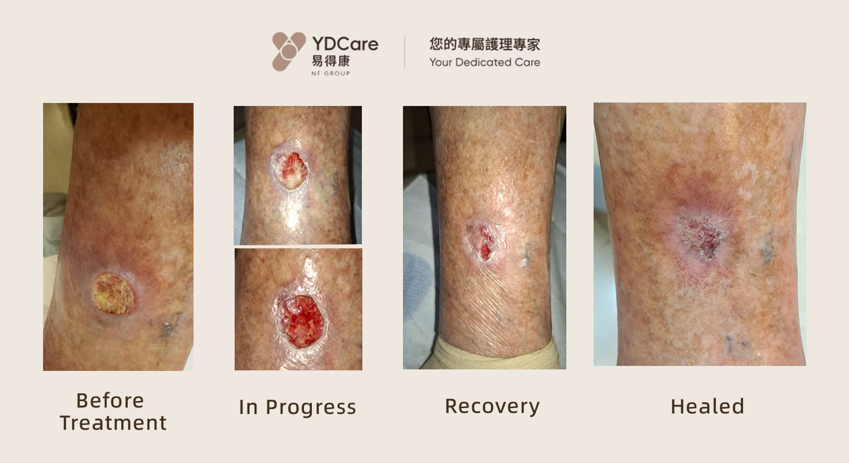 wound care