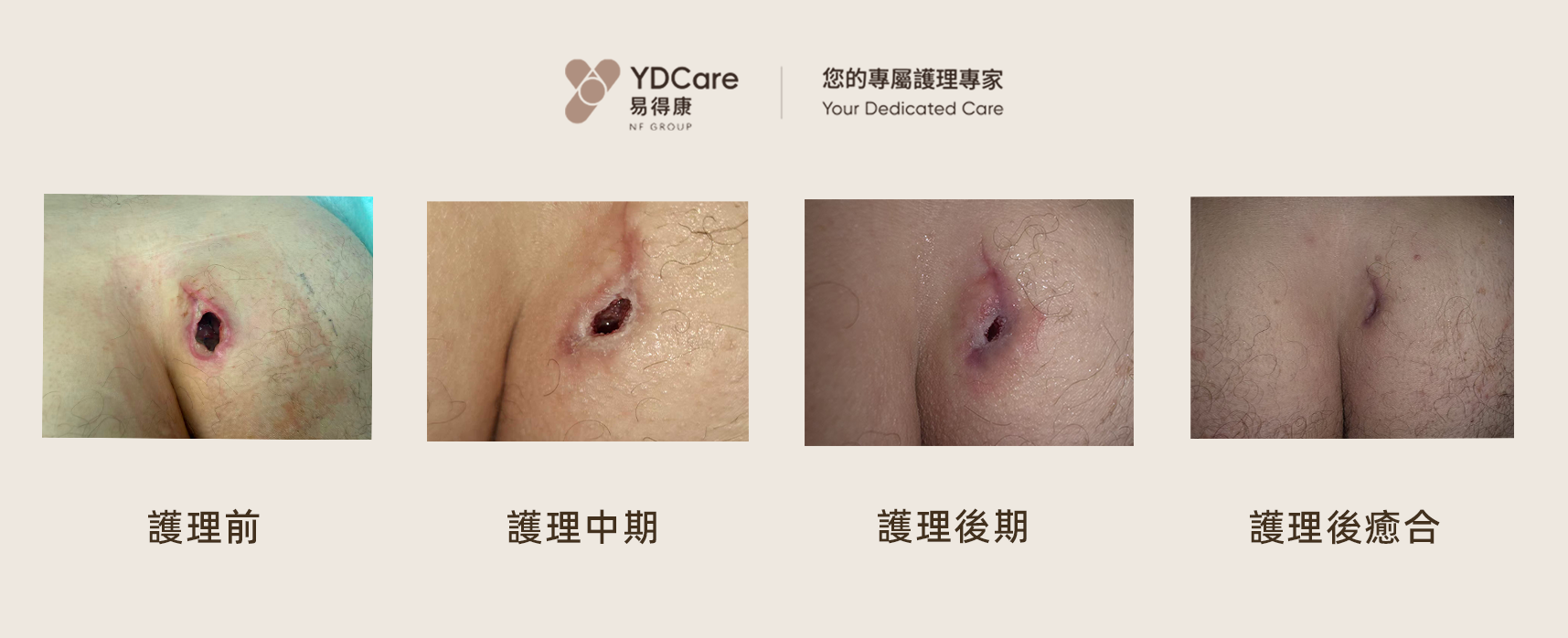 傷口護理