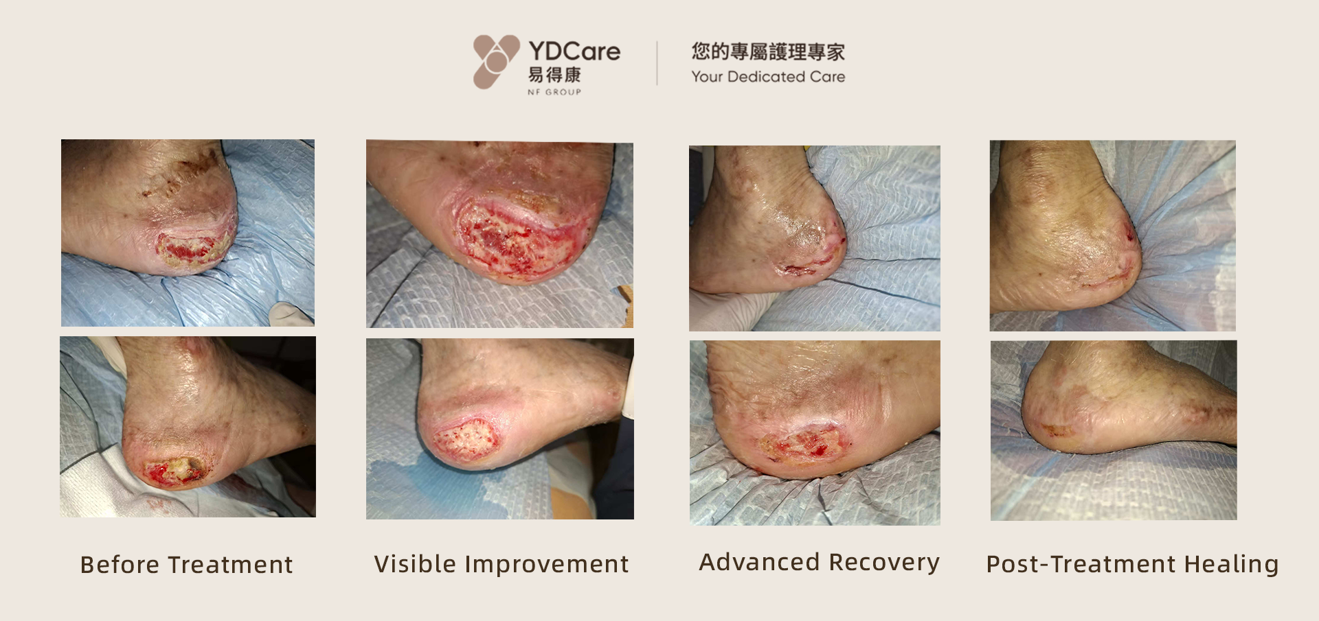 Pressure ulcer at home wound care