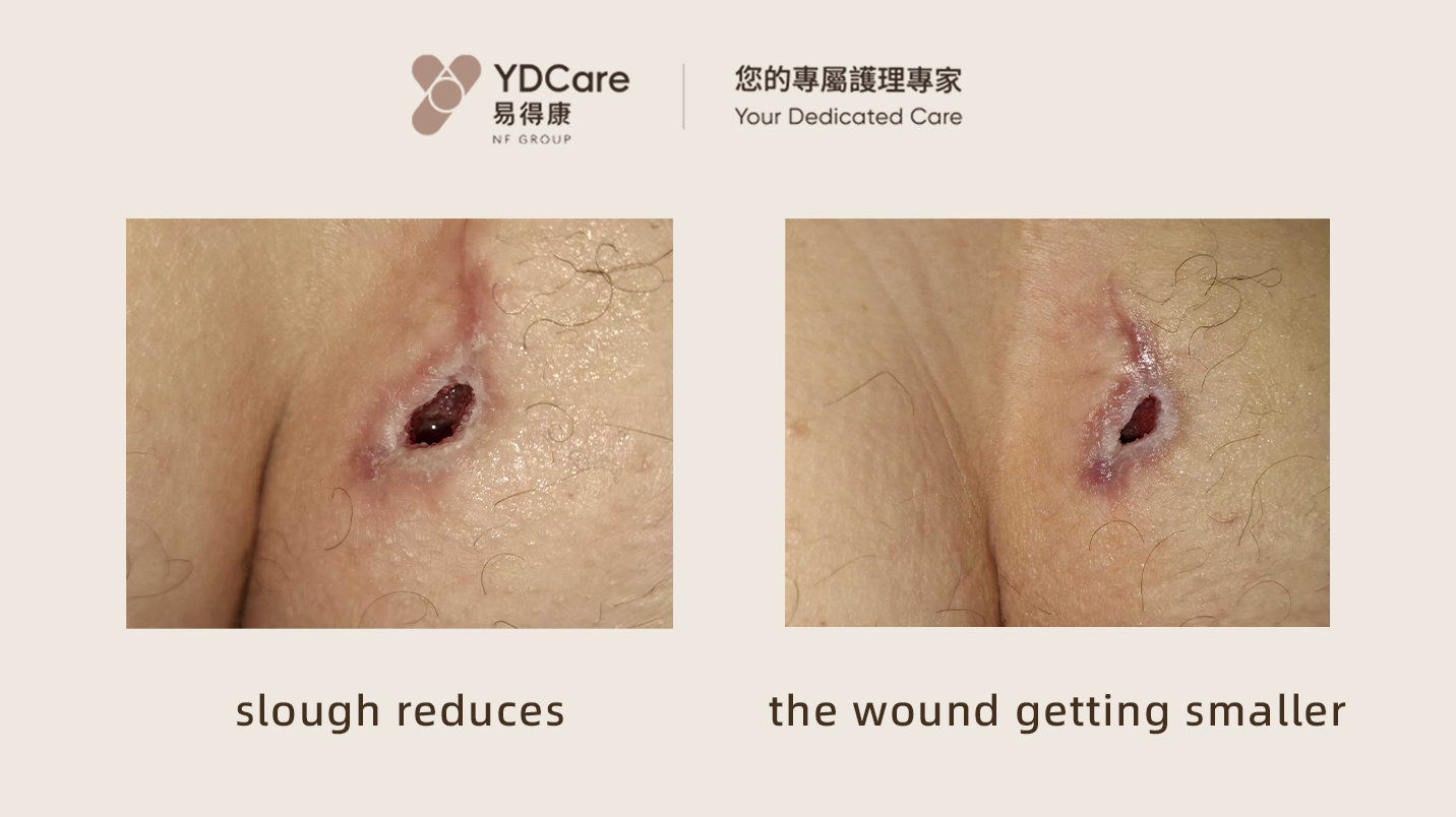 wound debriment