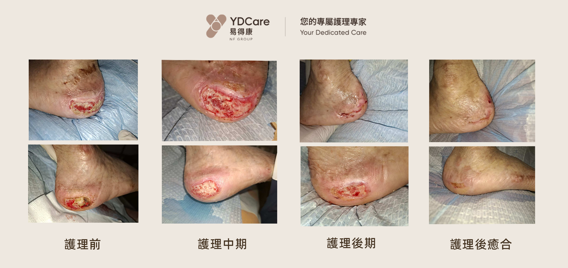 壓瘡護理 前後對比