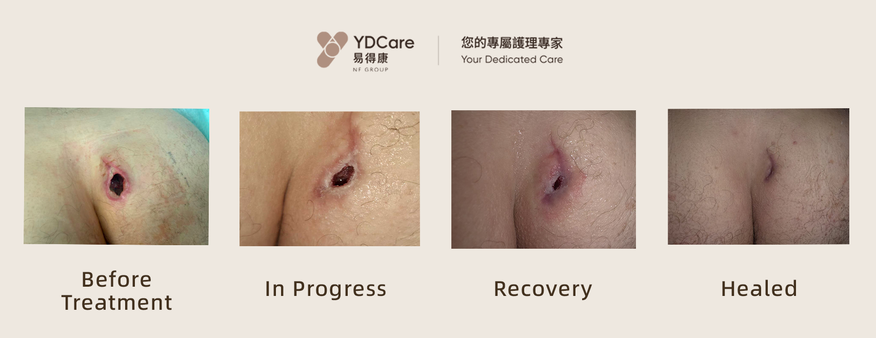 wound care