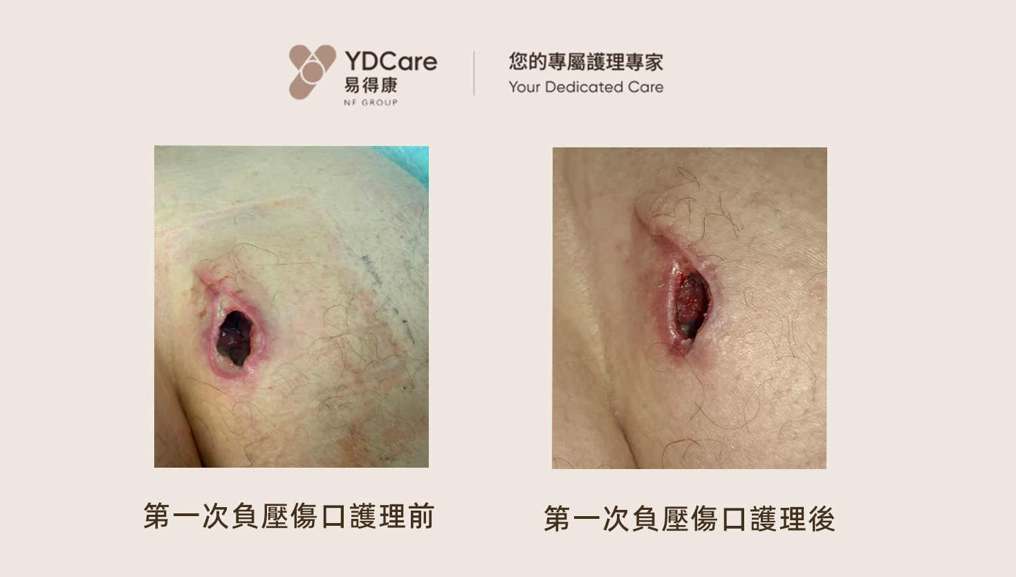負壓傷口治療