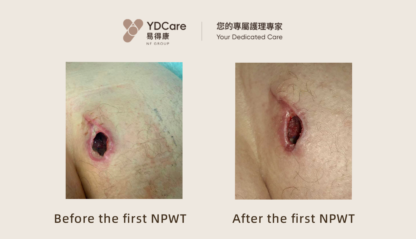 Negative Pressure Wound Therapy