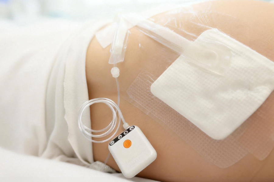 為甚麼負壓傷口治療（NPWT）可加速傷口癒合？